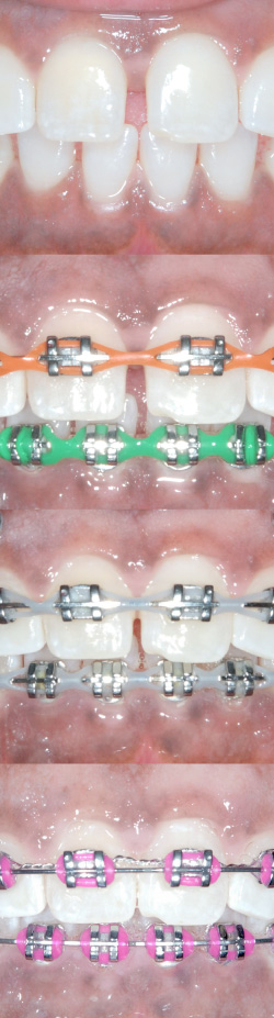 Braces treatment progress