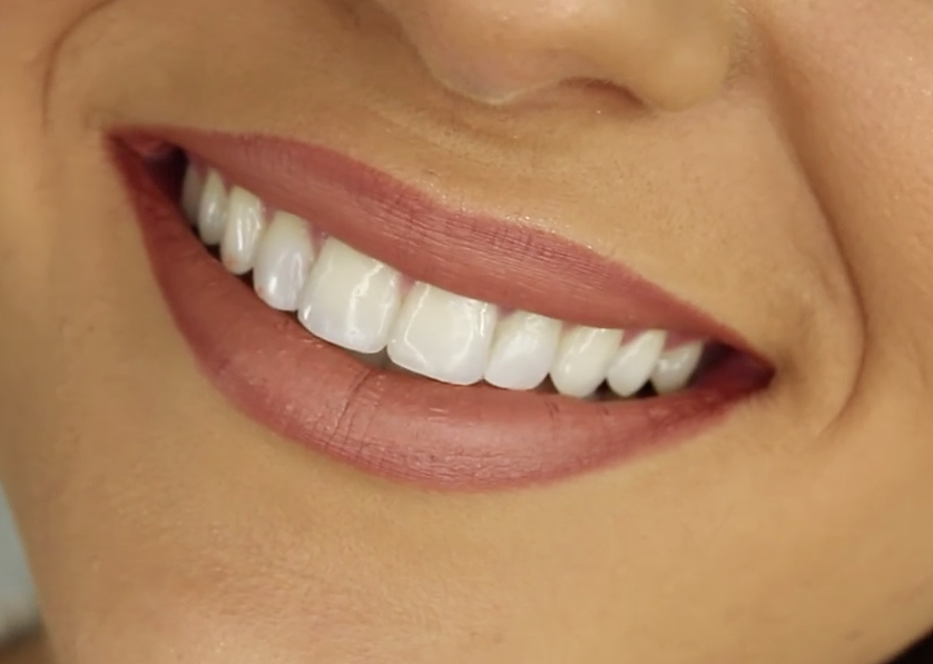 Bright clean smile after scaling and polishing