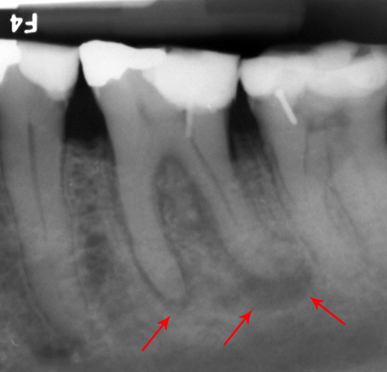Dental X-ray used to plan root canal treatment